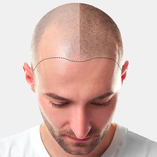 Tricopigmentation Lille