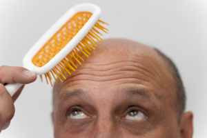 Tricopigmentation-homme-chauve-brosse