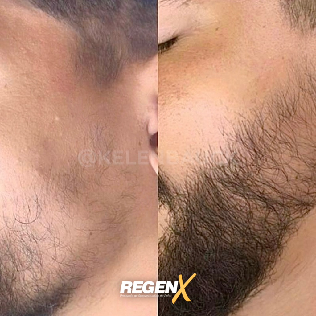 RegenX - Solution barbe clairsemée Lille