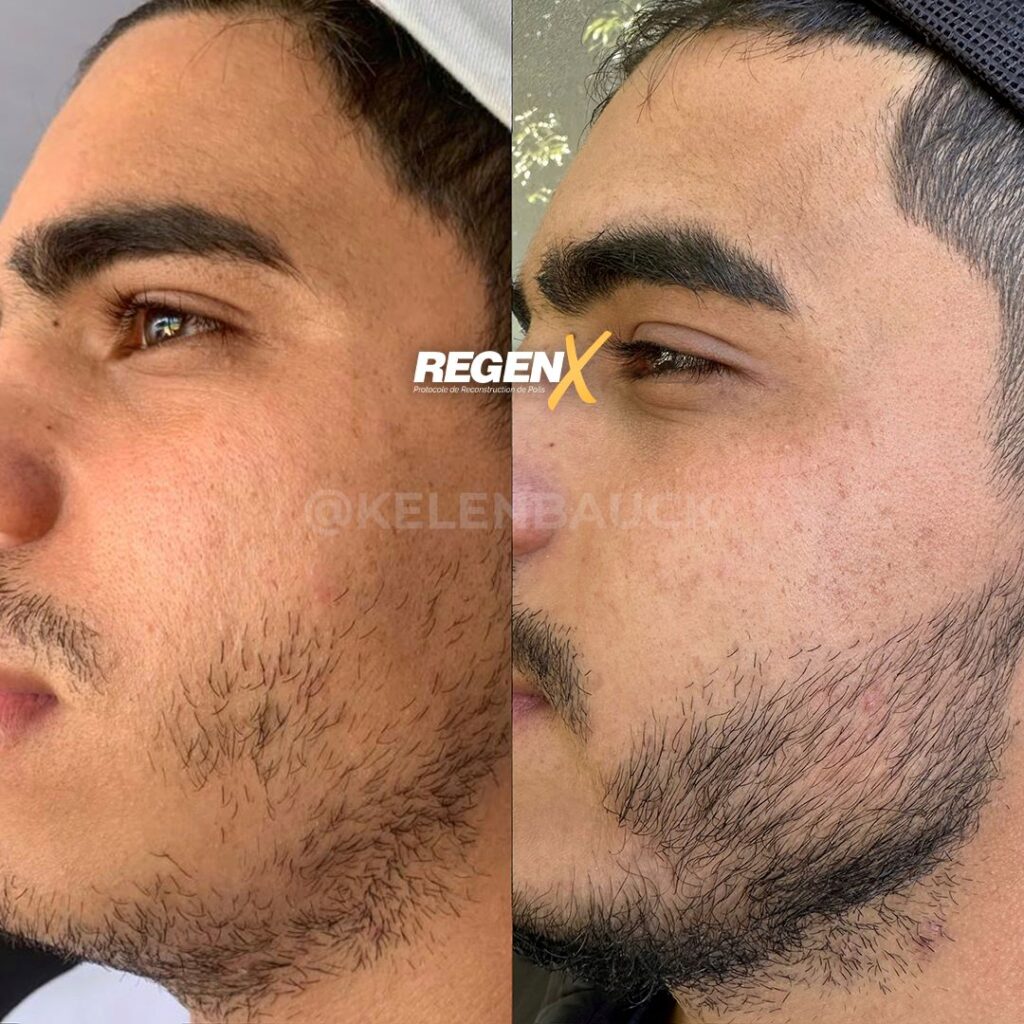 RegenX - Solution barbe clairsemée Lille
