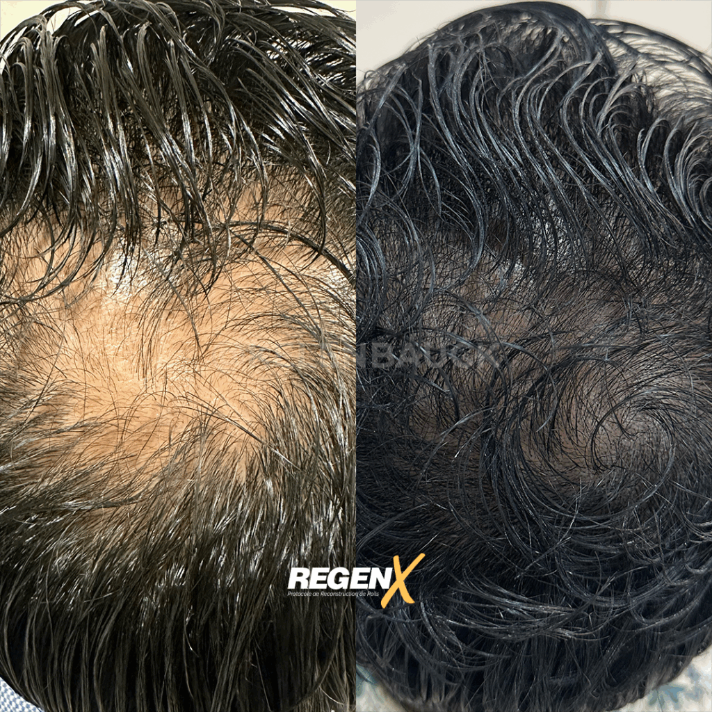 RegenX - Solution alopécie et perte de cheveux à Lille