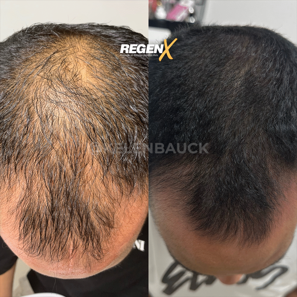 RegenX - Solution calvitie et perte de cheveux à Lille