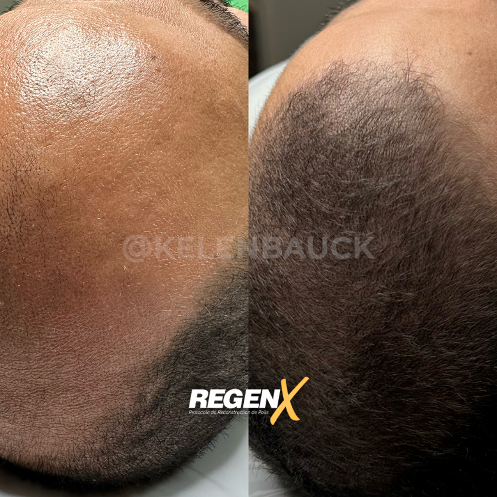 RegenX - Traitement calvitie et perte de cheveux à Lille