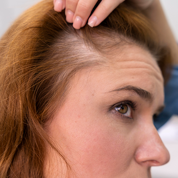 Traitement perte de cheveux à Lille, alopécie ou calvitie