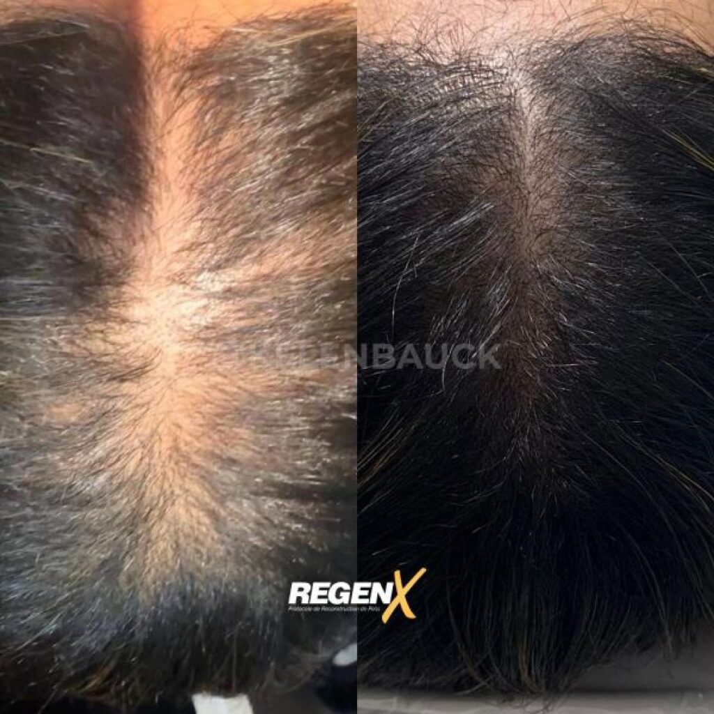 RegenX - Traitement alopécie et perte de cheveux à Lille