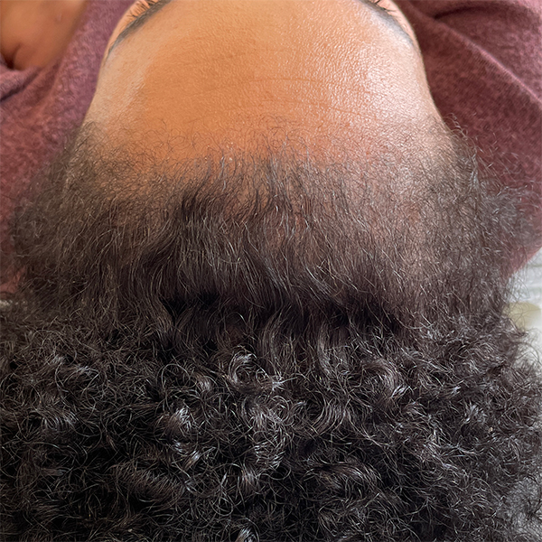 Tricopigmentation avant après densité - Tatouage cheveux -DermoKliniK Hem