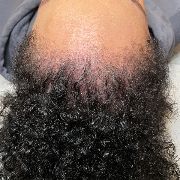 Tricopigmentation avant après densité - Tatouage cheveux -DermoKliniK Hem