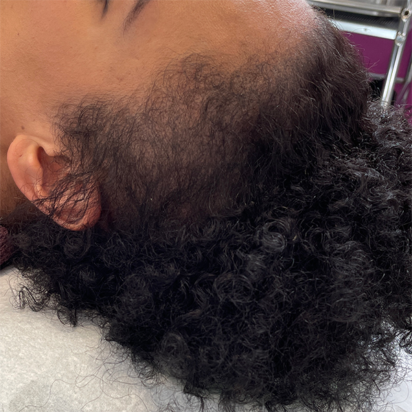 Tricopigmentation avant après densité cheveux crépus - Tatouage cuir chevelu -DermoKliniK Hem