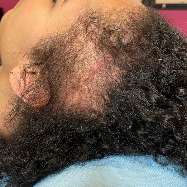 Tricopigmentation avant après densité cheveux crépus - Tatouage cuir chevelu -DermoKliniK Hem
