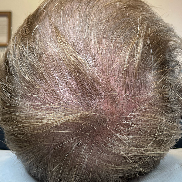 Tricopigmentation cheveux blonds avant après - Pigmentation cuir chevelu -DermoKliniK Hem