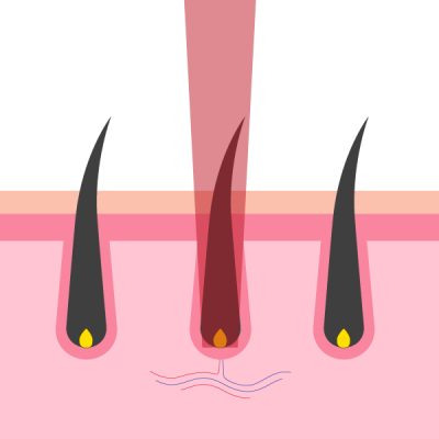 Fonctionnement épilation laser